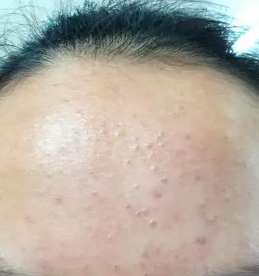 消除额头痘痘的小妙招（告别额头痘痘）