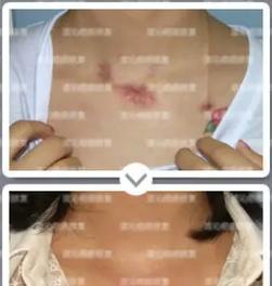 拍照腿上的疤用手机怎么p掉？如何用手机修掉照片中的疤痕？