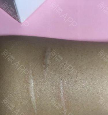 拍照腿上的疤用手机怎么p掉？如何用手机修掉照片中的疤痕？